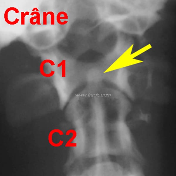 Subluxation atlanto-axiale chez le chien
