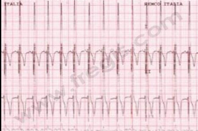 Endocardiose chez le chien