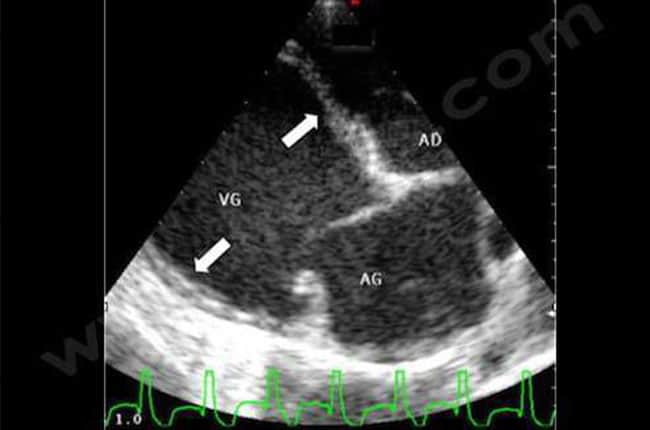 Cardiomyopathie dilatée (CMD) chez le chien et le chat
