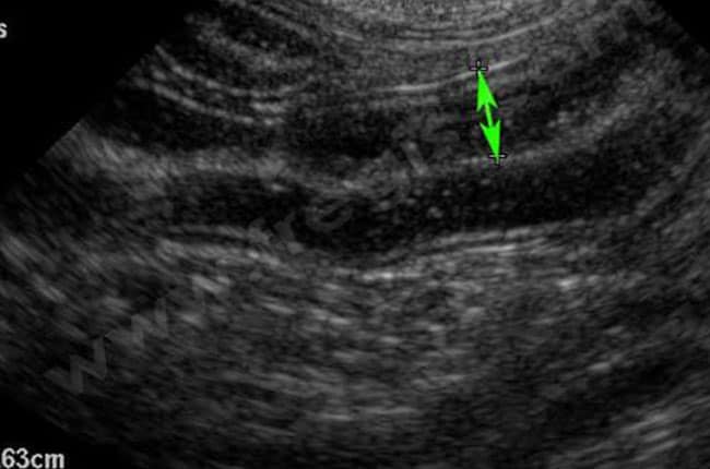 Entérite, colite et entérocolite lymphoplasmocytaire chez le chien