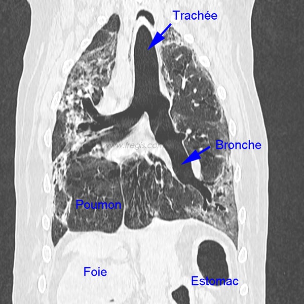 Fibrose pulmonaire interstitielle chez le chien