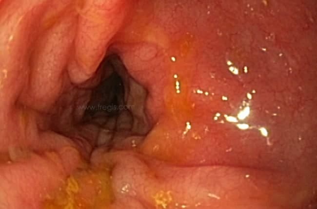 Gastroentérite éosinophilique, entérite éosinophilique et entérocolite éosinophilique chez le chien