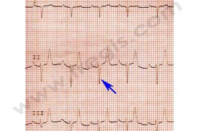 Sténose pulmonaire chez le chien