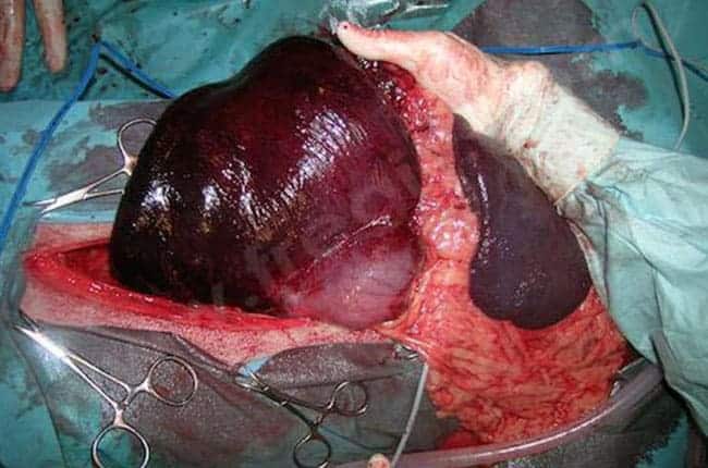 Syndrome de dilatation torsion de l'estomac chez le chien