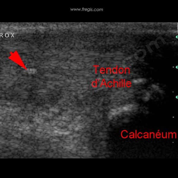 Atteinte (et "rupture") du tendon d'Achille (corde du jarret) chez le chien