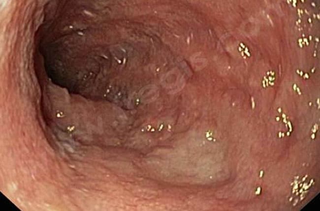 Entérite, colite et entérocolite lymphoplasmocytaire chez le chien