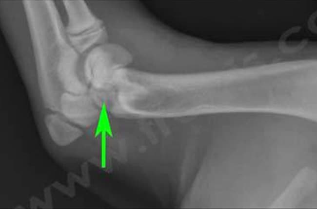 Fractures pédiatriques (ou fractures de type Salter Harris) chez le chien