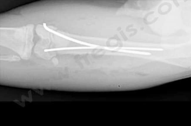 Fractures pédiatriques (ou fractures de type Salter Harris) chez le chat