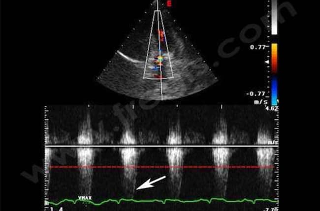 Sténose pulmonaire chez le chien