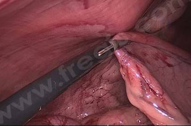 Syndrome de dilatation torsion de l'estomac chez le chien