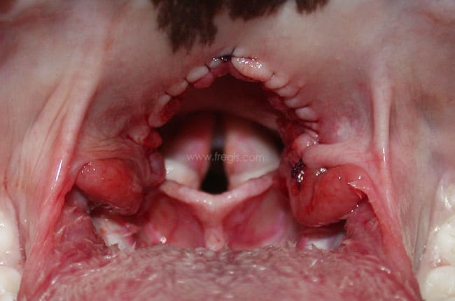 Hypoplasie trachéale chez le chien