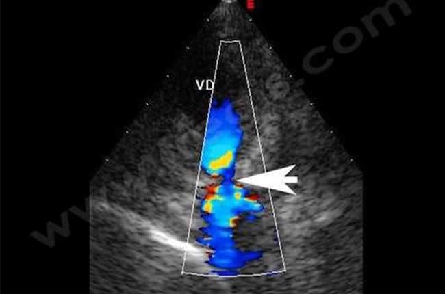 Sténose pulmonaire chez le chien