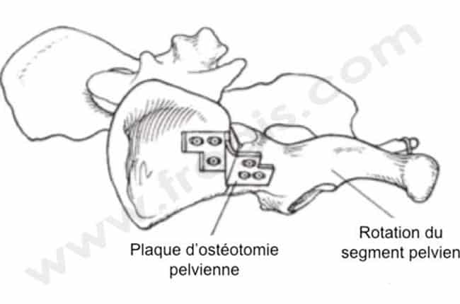 Double et Triple Ostéotomie du Bassin (DOB, TOB) chez le chien