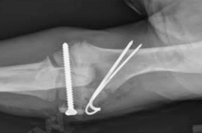 Fractures pédiatriques (ou fractures de type Salter Harris) chez le chien