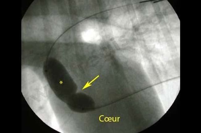 Sténose pulmonaire chez le chien