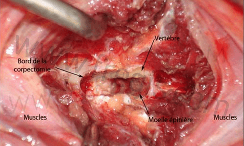 Corpectomie
