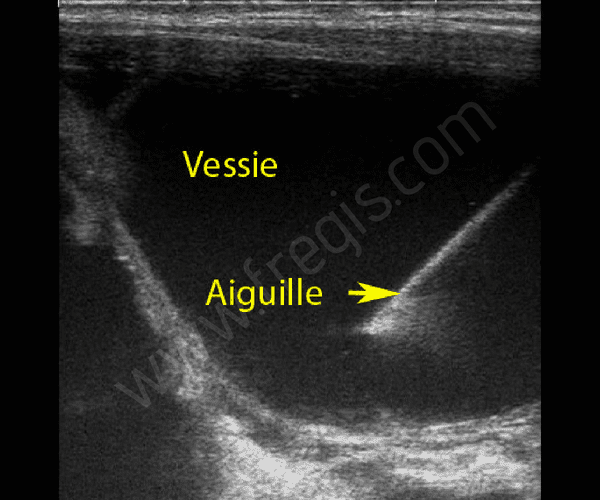 Cystocentèse