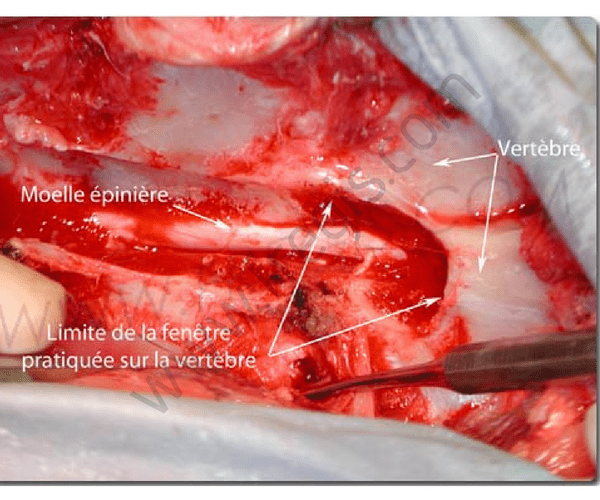 Hémilaminectomie