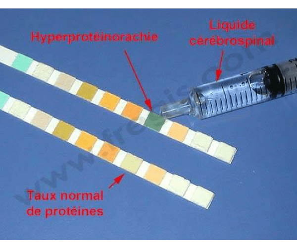 Hyperprotéinorachie