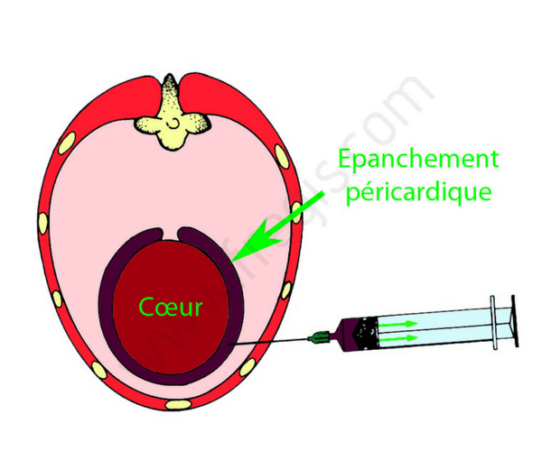 Péricardiocentèse