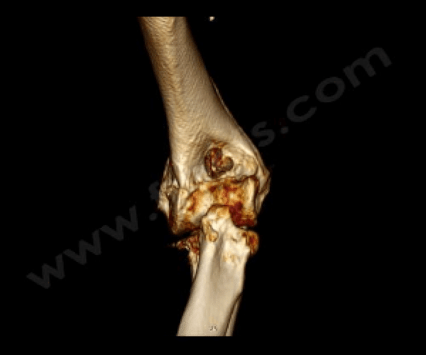 Arthrose