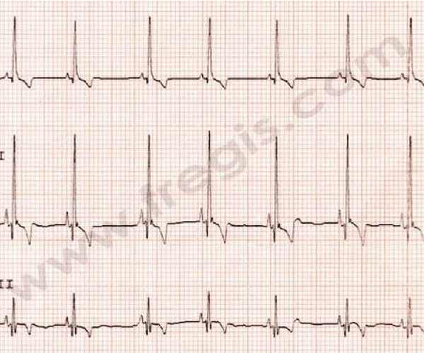 Electrocardiographie