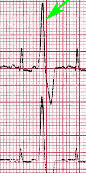 Extrasystole ventriculaire chez un chien