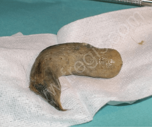 Trichobézoard