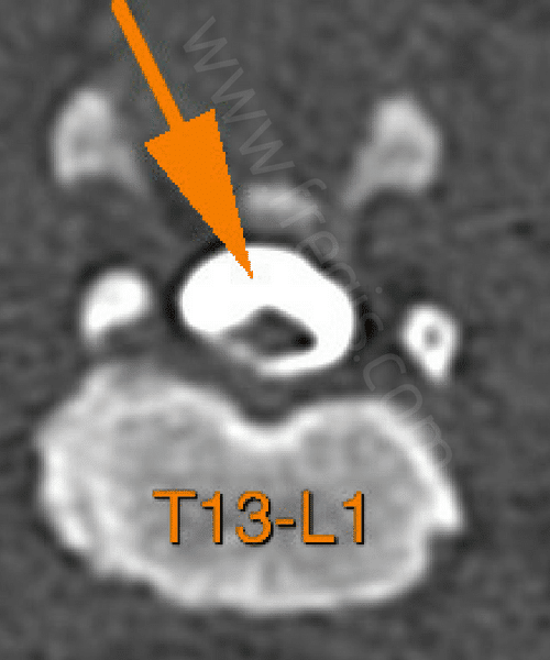 Myéloscanner sur un chien de race Carlin montrant un diverticule arachnoïdien (coupe transverse).