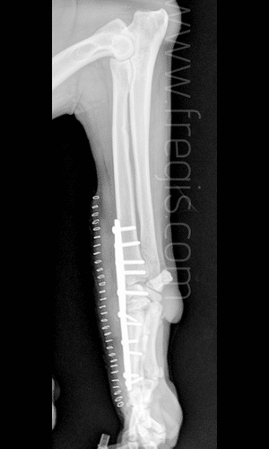 Syndrome d’hyperextension