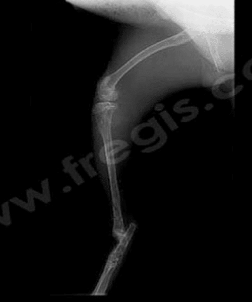 Tibia après retrait du montage orthopédique