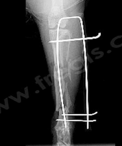 Montage orthopédique sur une fracture multiple sur un Lapin