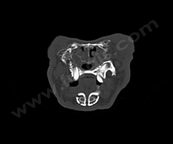 Scanner mettant en évidence du pus dans les deux sinus et une rhinite d’origine bactérienne