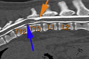 Myéloscanner sur un chien montrant un diverticule arachnoïdien (flèche orange) et discrète protrusion discale (flèche bleue)