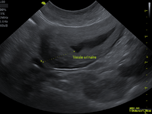 Echographie abdominale