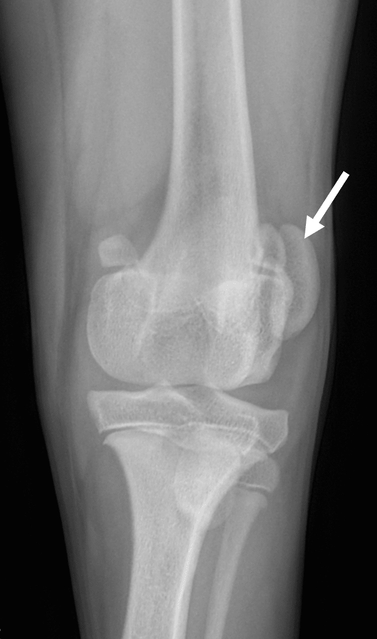 Radiographie de face d’une luxation latérale de la rotule de grade 3 chez un chien. La rotule est déplacée vers l’extérieur.