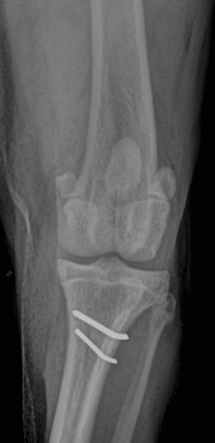 Radiographie de face et de profil suite à correction chirurgicale de la luxation de la rotule chez un chien par transposition de la crête tibiale.