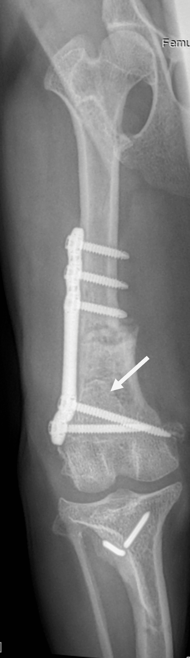 Radiographie de face suite &agrave; correction chirurgicale de la luxation de la rotule chez un chien par d&eacute;torsion f&eacute;morale et transposition de la cr&ecirc;te tibiale.