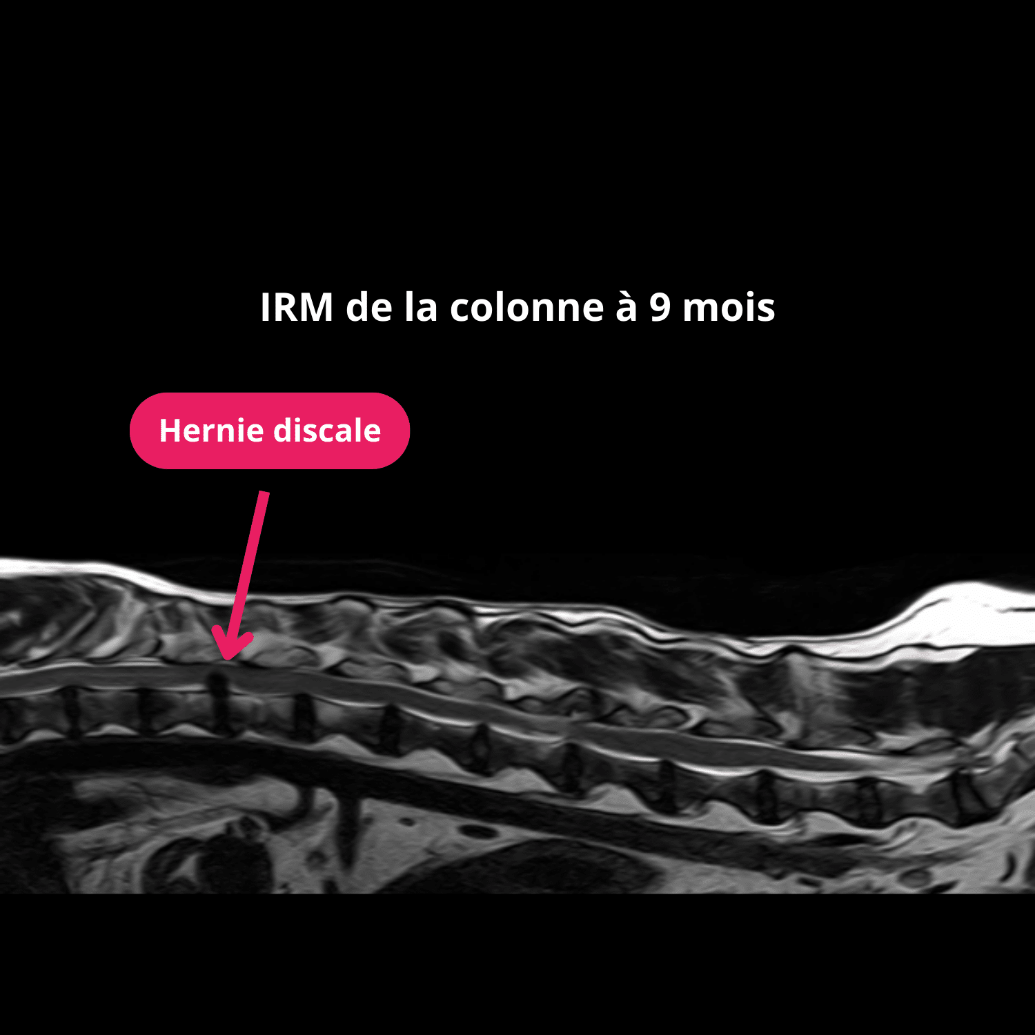 Coupe sagittale en pondération T2 à 9 mois