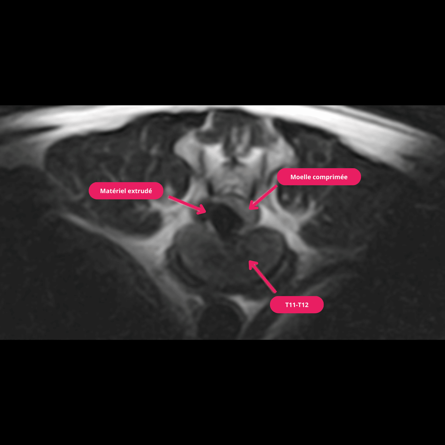 Coupe transversale en pondération T2 à 9 mois