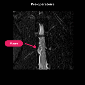 Coupe dorsale en pondération T2 STIR préopératoire