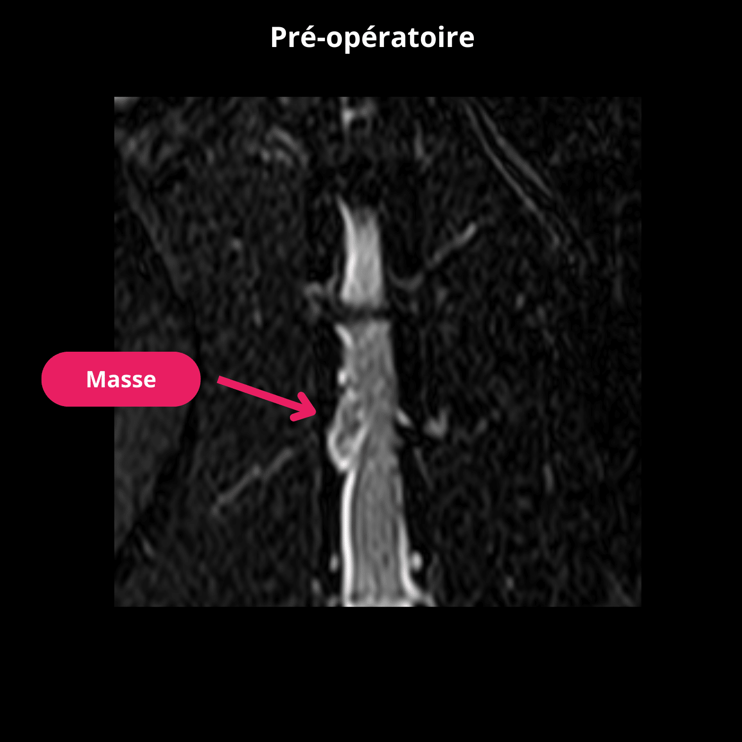 Coupe dorsale en pondération T2 STIR préopératoire