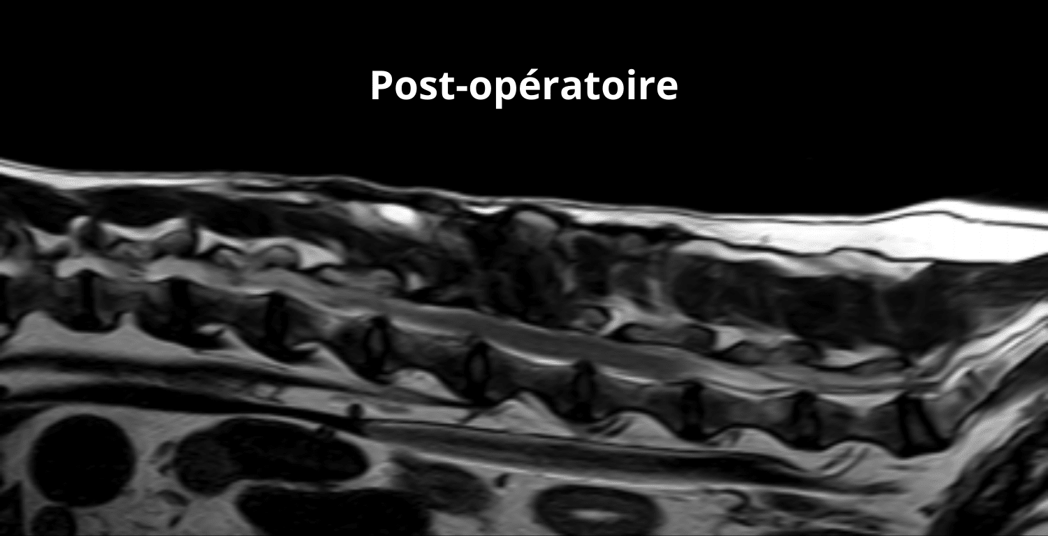 Coupe sagittale en pondération T2 postopératoire à 5 mois