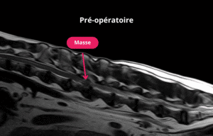Coupe sagittale en pondération T2 préopératoire