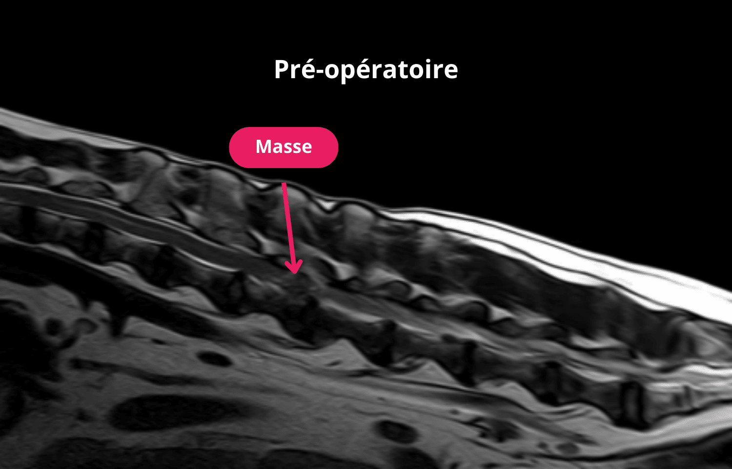 Coupe sagittale en pondération T2 préopératoire