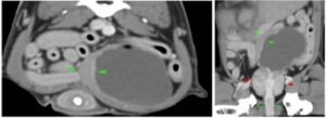 Scanner thoraco-abdominal