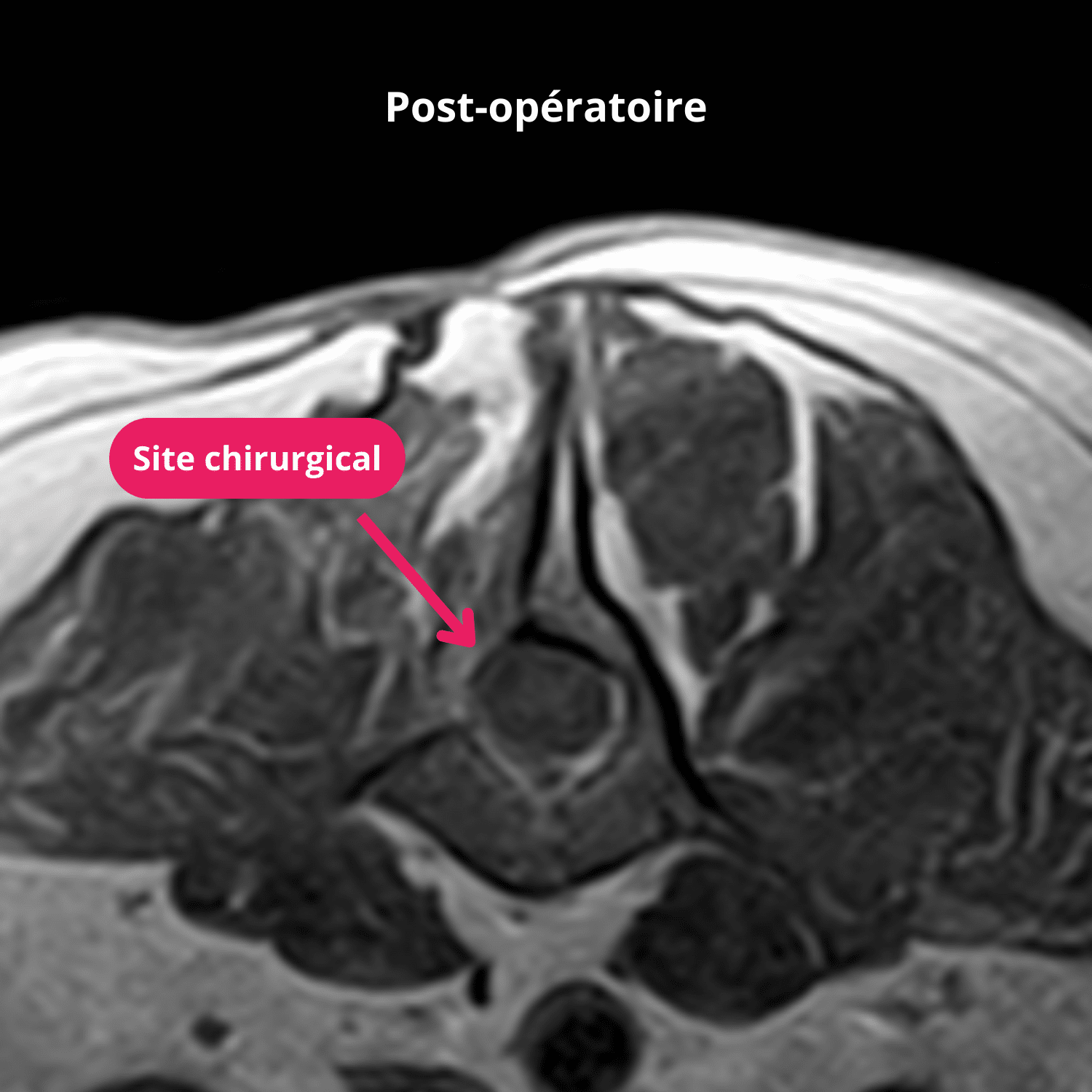 Coupe transversale en pondération T1 postopératoire à 5 mois