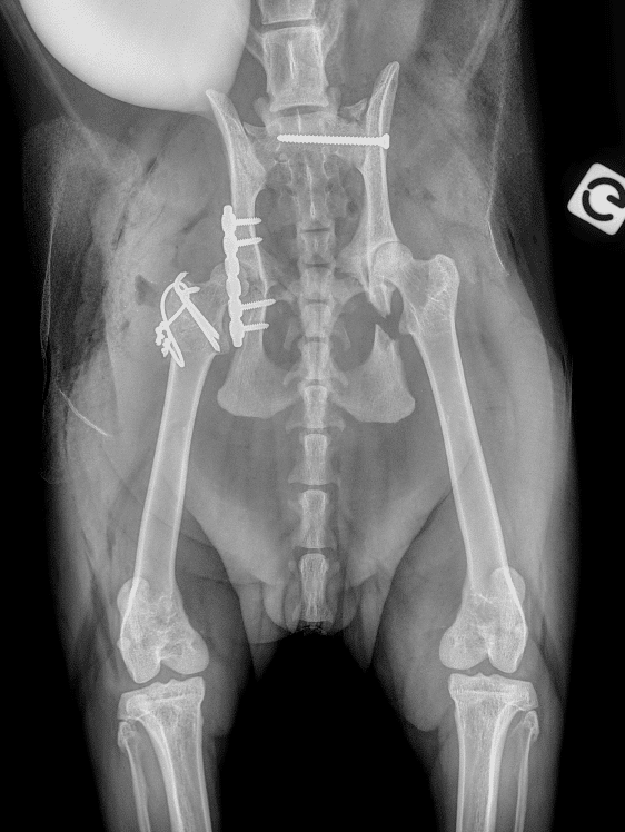 La chirurgie du bassin a permis une stabilisation grâce à une plaque et un hauban. La disjonction sacro-iliaque a également été réparée par la mise en place d’une vis entre le sacrum et l’ilium.