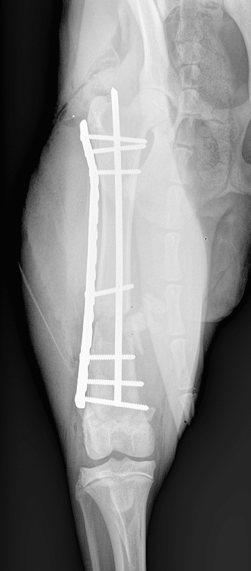 Radiographie de face du fémur droit – Ostéosynthèse de la fracture du fémur par clou centro-médullaire et plaque vissée.