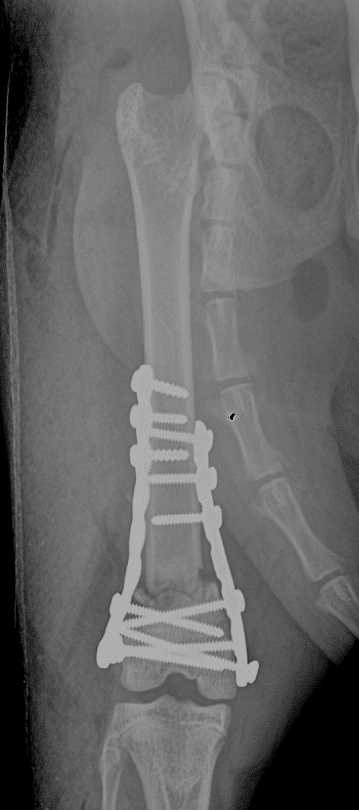 Radiographie de face du fémur droit – Ostéosynthèse d’une fracture très distale du fémur par une double plaque.
